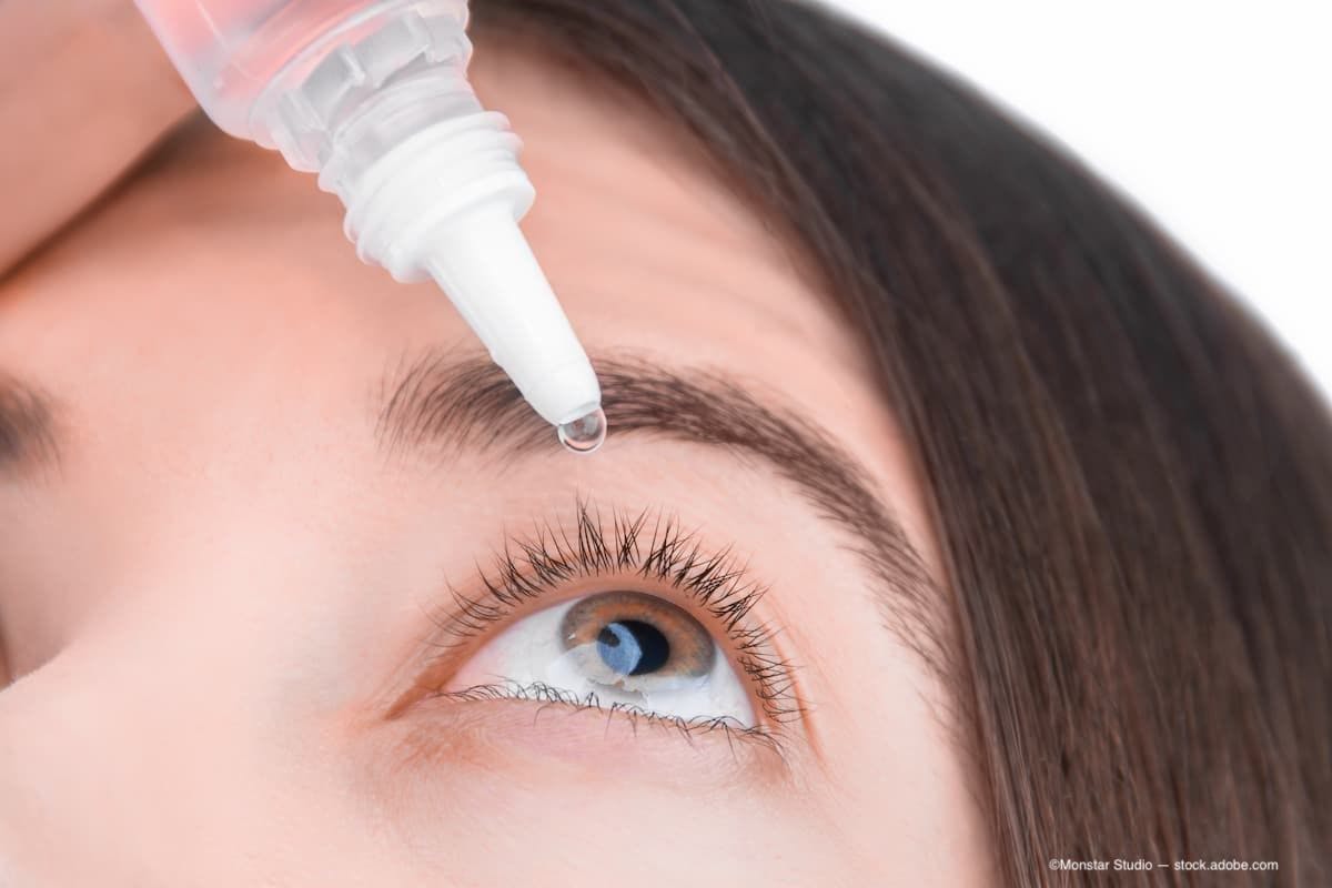 A woman putting eye drops in her eye. (Image Credit: AdobeStock/Monstar Studio)