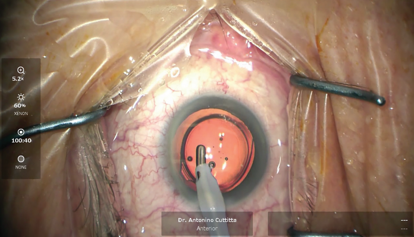 Examining stability of aspheric IOL in cataract patients 