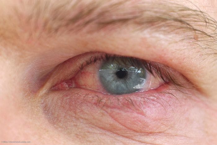 Managing dry eye key to patient satisfaction after cataract, refractive surgeries