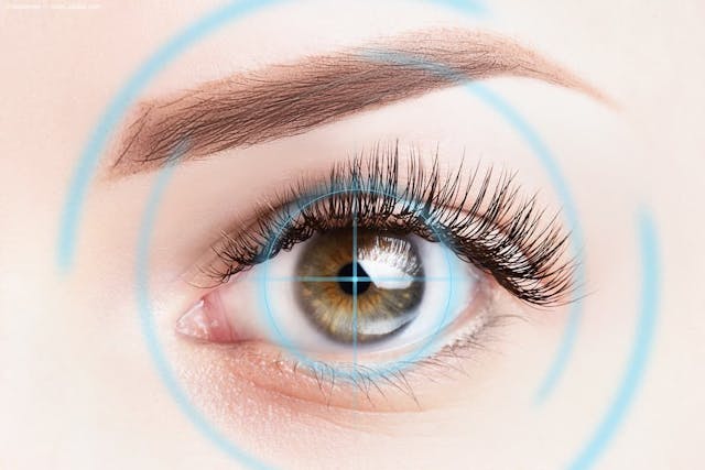Case-controlled study explores hypothesized association between LASIK and early cataract surgery