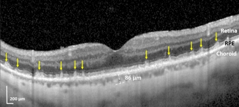 The abnormal subretinal drusenoid deposits (SDDs) are the multiple, gray, conical lesions (yellow arrows) sitting on top of the bright white band known as the retinal pigment epithelium (RPE). They are pushing and penetrating the thin white retinal layer above them. All the other retinal layers further above are normal. The eye’s blood supply, seen below the RPE and known as the choroid, is abnormally thin because the weakened heart is not pumping enough blood to the eye.