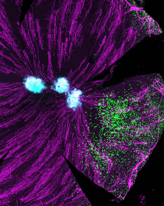 Immune cells (T cells, green) can be see entering the cornea of the eye, towards the Herpes Simplex virus infected cells (light blue). The eye is rich in nerves (purple). (Image courtesy of Doherty Institute)