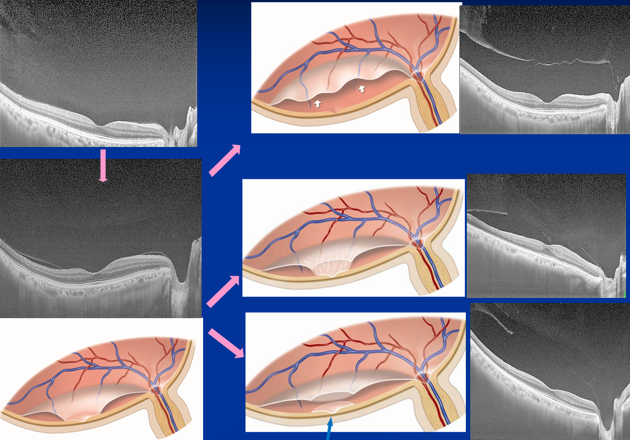 Figure 4 The early phase of PVD progression. PVD progression bigins from the state of No PVD (upper left) to the vicinity of the outer periphery of the macula (bottom left), then PVD spreads throughout the posterior pole (upper right). In many cases, an oval defect in the posterior vitreous cortex is formed (middle or lower right), and the thin posterior vitreous cortex remains on the macular retina (blue arrow). Among them, there are two types of shallow PVD with an oval defect in the posterior vitreous cortex. Shallow PVD with vitreous gel attachment to the macula through the premacular oval defect of posterior vitreous cortex (middle right) and no vitreous gel attachment to the macula (bottom right).