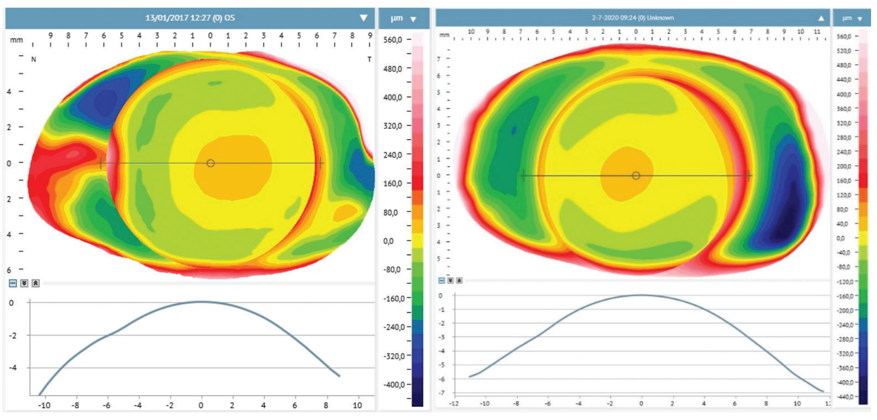 The relationship between myopia and conjunctival-scleral geometry