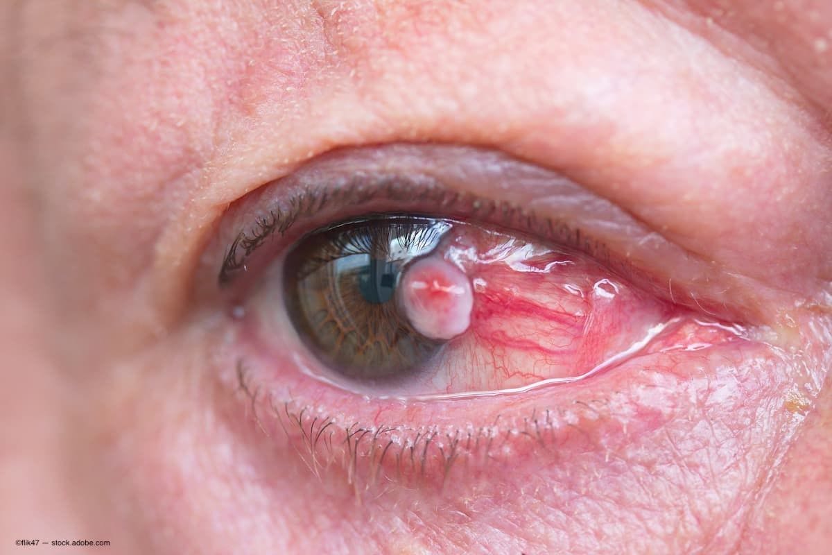 Pigmented lesions on ocular surface require various approaches