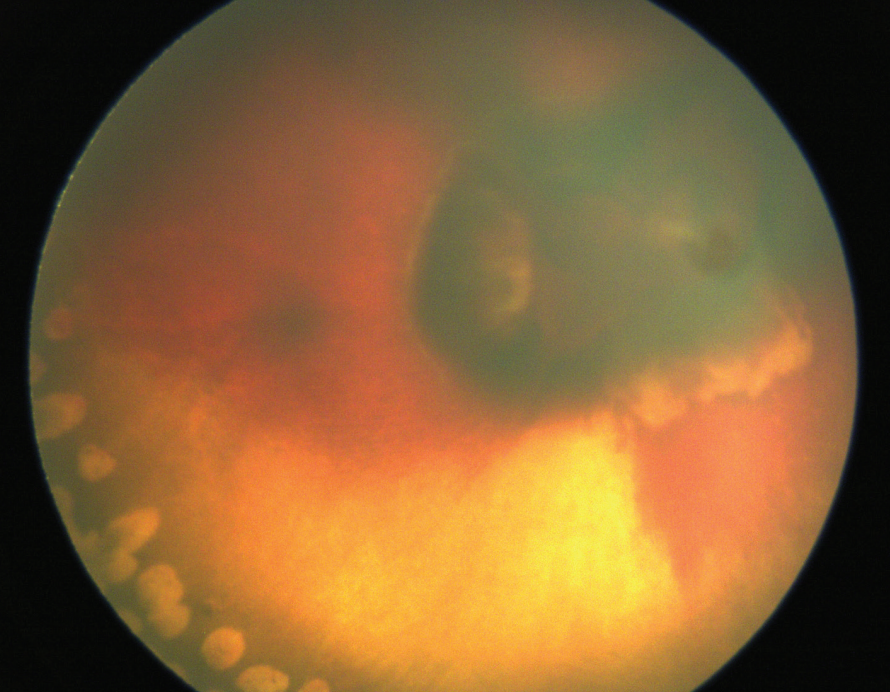 Fundus photo 1 month following laser treatment for Norrie disease. 