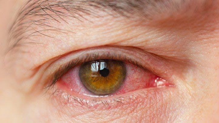 Oculis announces Phase 2 data for topical drops to treat dry eye disease