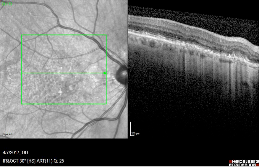 Figure 2. OCT OD showing a very small nasal to fovea pigment epithelial detachment (PED) with trace hyper-reflective subretinal material (SHRM) but no frank subretinal or intraretinal fluid.