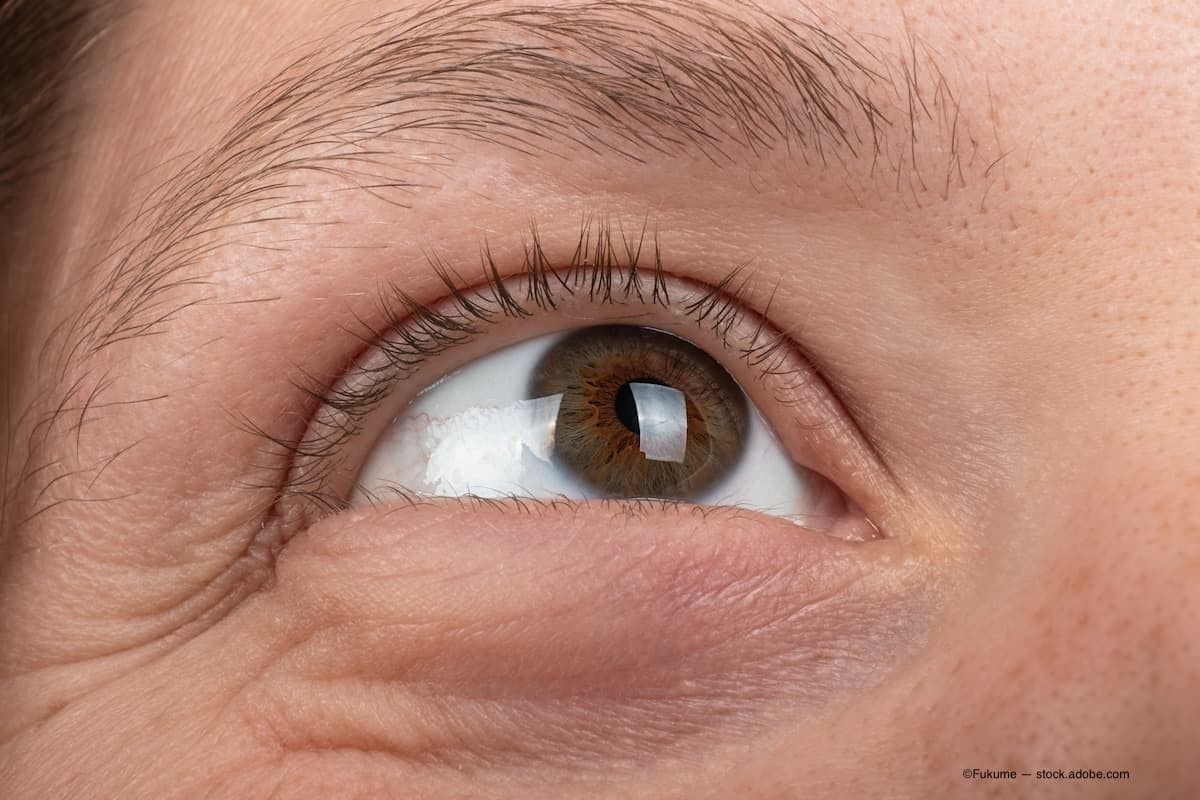 Close image of an eye with keratoconus