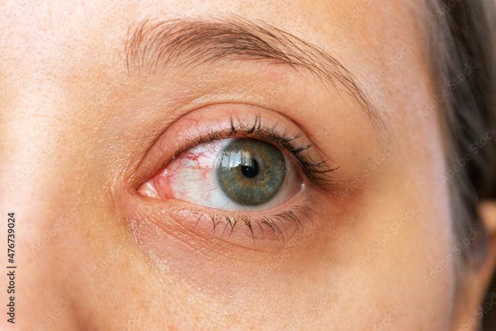 New diagnostic option for rare eye disease 