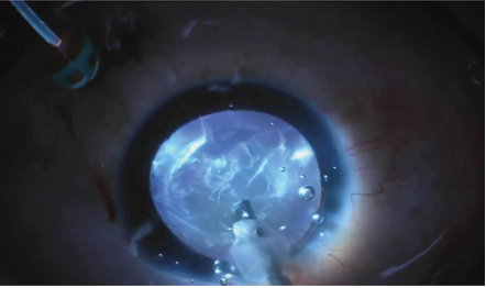 Shedding light on vitreous opacities during cataract surgery