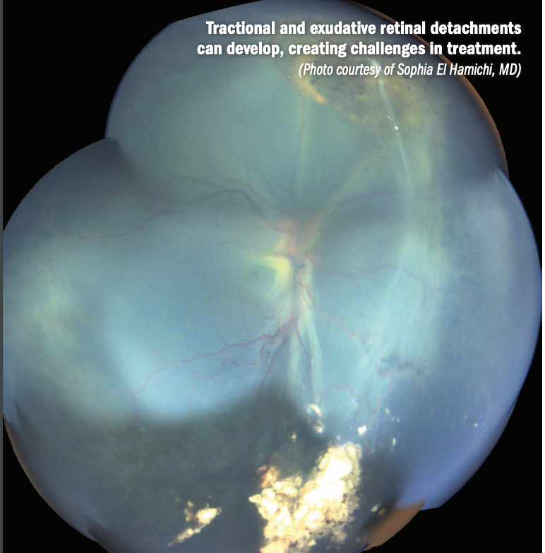 Persistent retinal detachment related to retinoblastoma