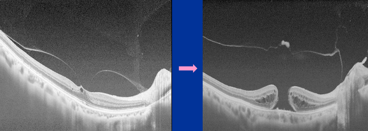 Figure 5 THe mechanism of macular hole development. OCT findings clearly show that Shallow PVD, which leaves pinpoint adhesion in the fovea (left), is the cause of macular hole (right).