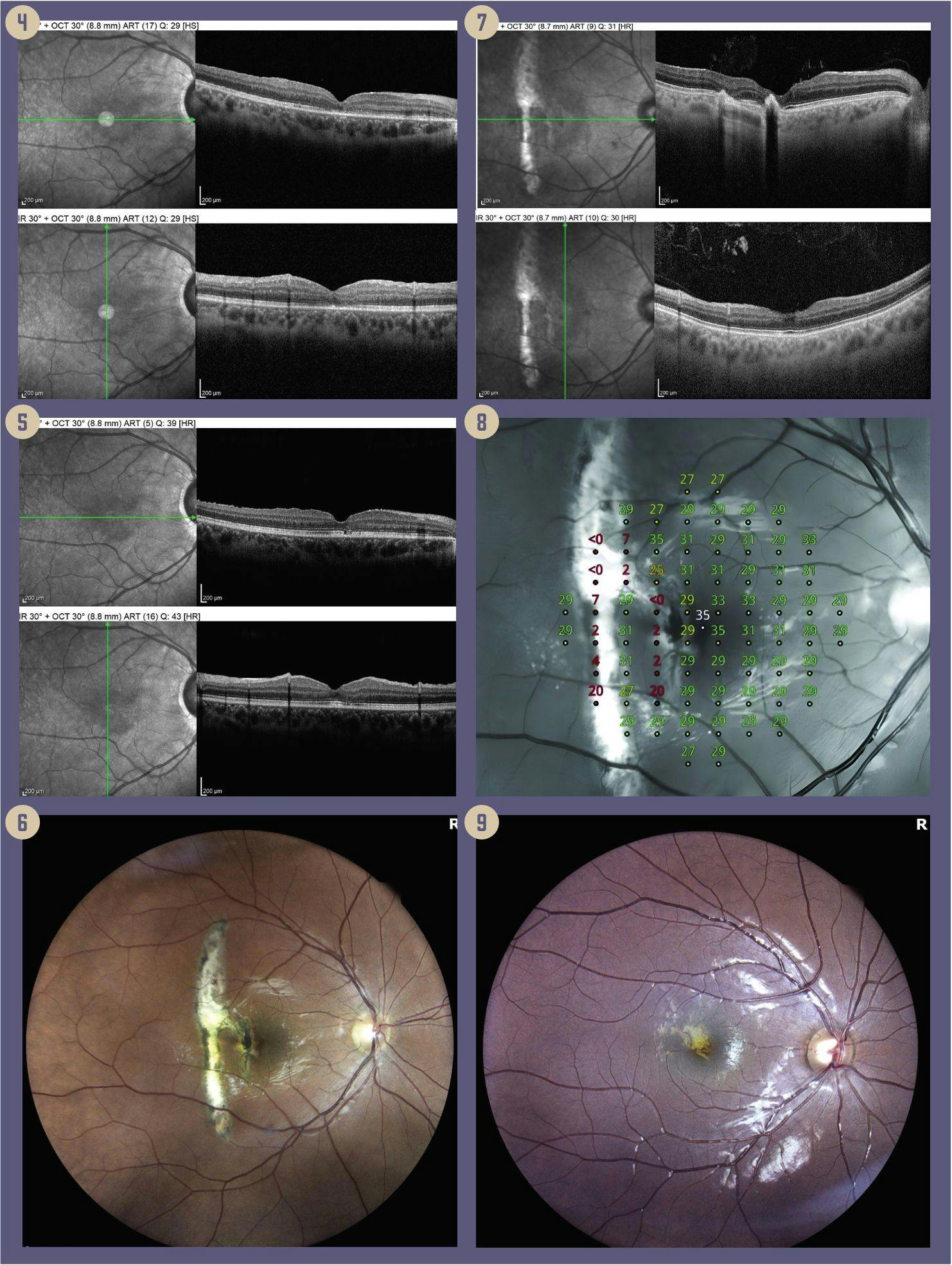 Figures: 4: OCT (post op 2 months) closure of macular hole with resolution of cystoid hydration (Vac 20/50). 5: OCT (post op 1 year) closure of macular hole with resolution of cystoid hydration and improvement in the photoreceptor layer (Vac 20/25). 6: Fundus photo with traumatic choroidal rupture. 7: OCT revealing 2 breaks in Bruch membrane with intact photoreceptors centrally without edema. 8: Microperimetry consistent with paracentral scotoma and preserved 20/20 central vision. 9: A fundus photo with laser