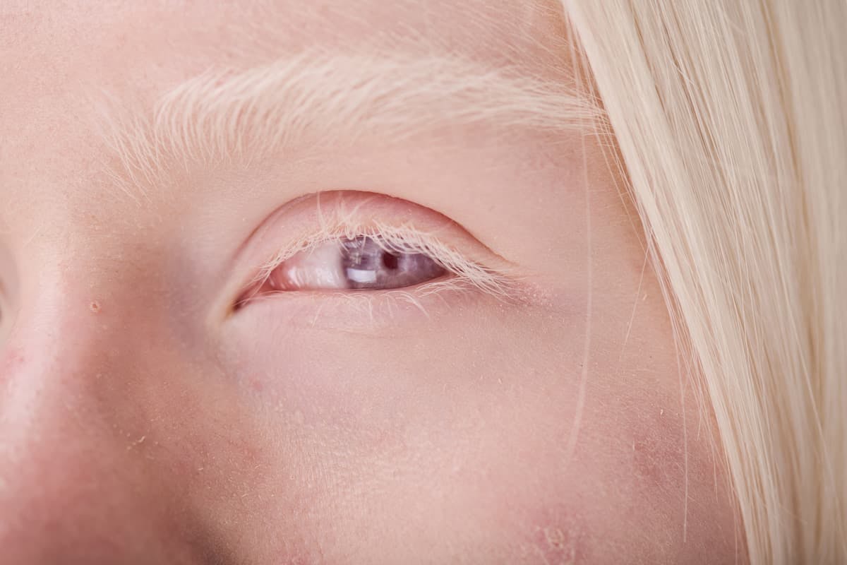 close image of an albino woman's eye (Image Credit: AdobeStock/AnnaStills)