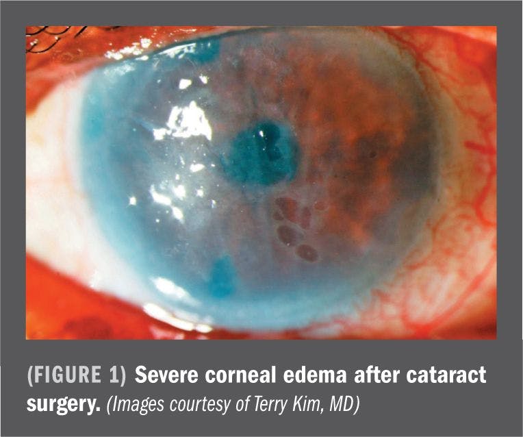 Considering BID ocular steroid post-cataract surgery