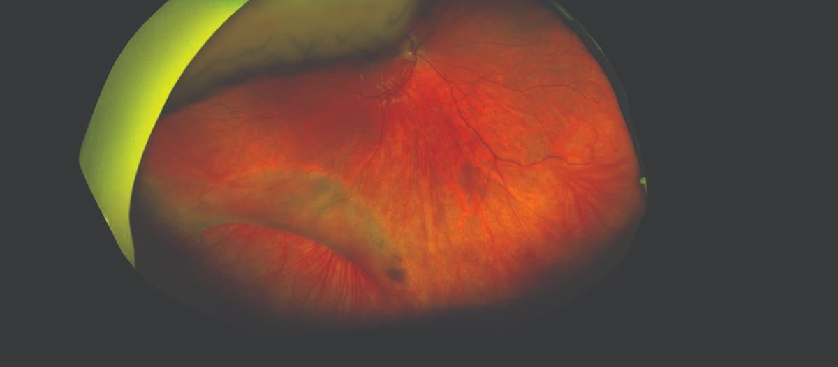 Retinoschisis, which was determined to be linked with a retinal detachment, was detected on ultra-widefield imaging during a 13-year-old patient’s first routine eye exam. (Image courtesy of Douglas Katsev, MD)