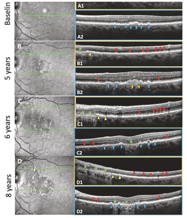 Soft drusen and subretinal drusenoid deposits (SDDs evolving and progressing to geographic atrophy (GA) in the same eye over 8 years with residual basal laminar deposit (BLamD) in a 79-year-old female. Left: NIR images. Right: SD-OCT B scans. Boxes outlined with orange, scans through an SDD region. Boxes outlined with blue, scans through a soft drusen region.
