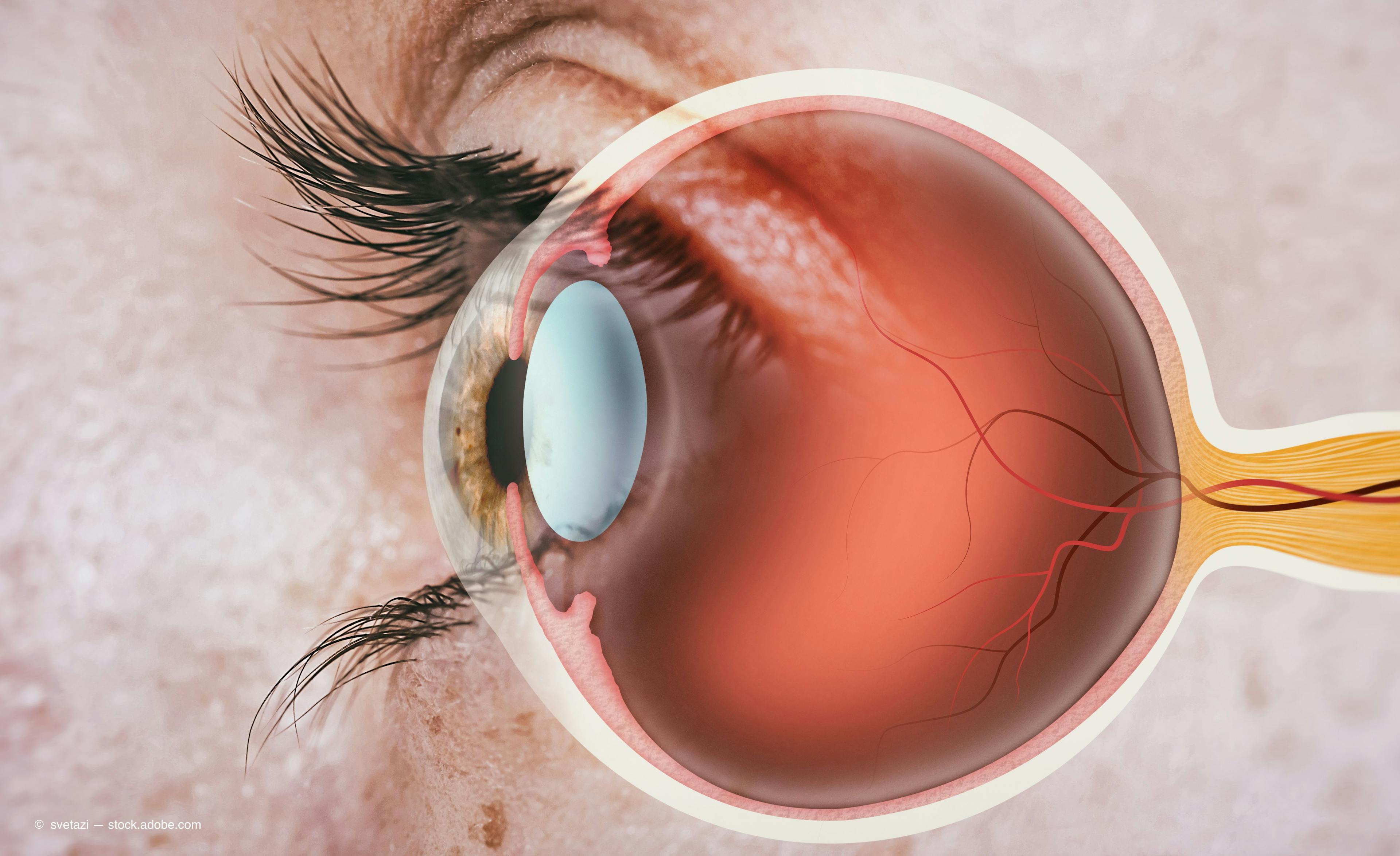 DED results in imbalance of neuropeptides, neurotrophins in the cornea and trigeminal ganglion