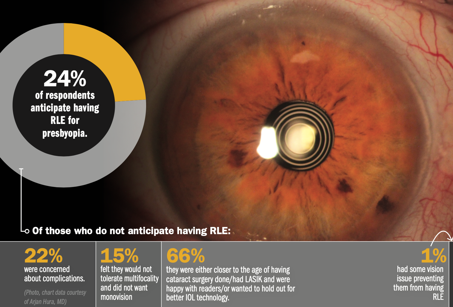 Dispelling myths about refractive lens exchange