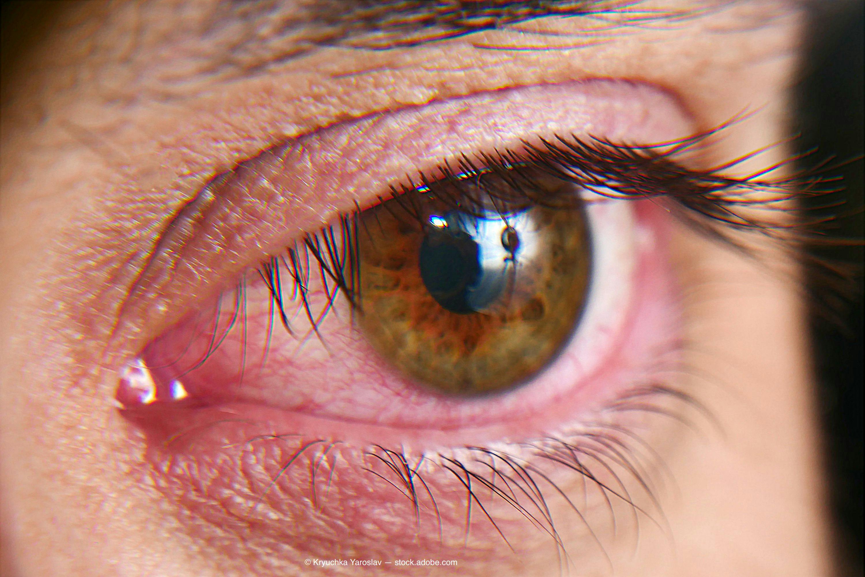 Treatment option for dry eye secondary to graft-vs-host disease