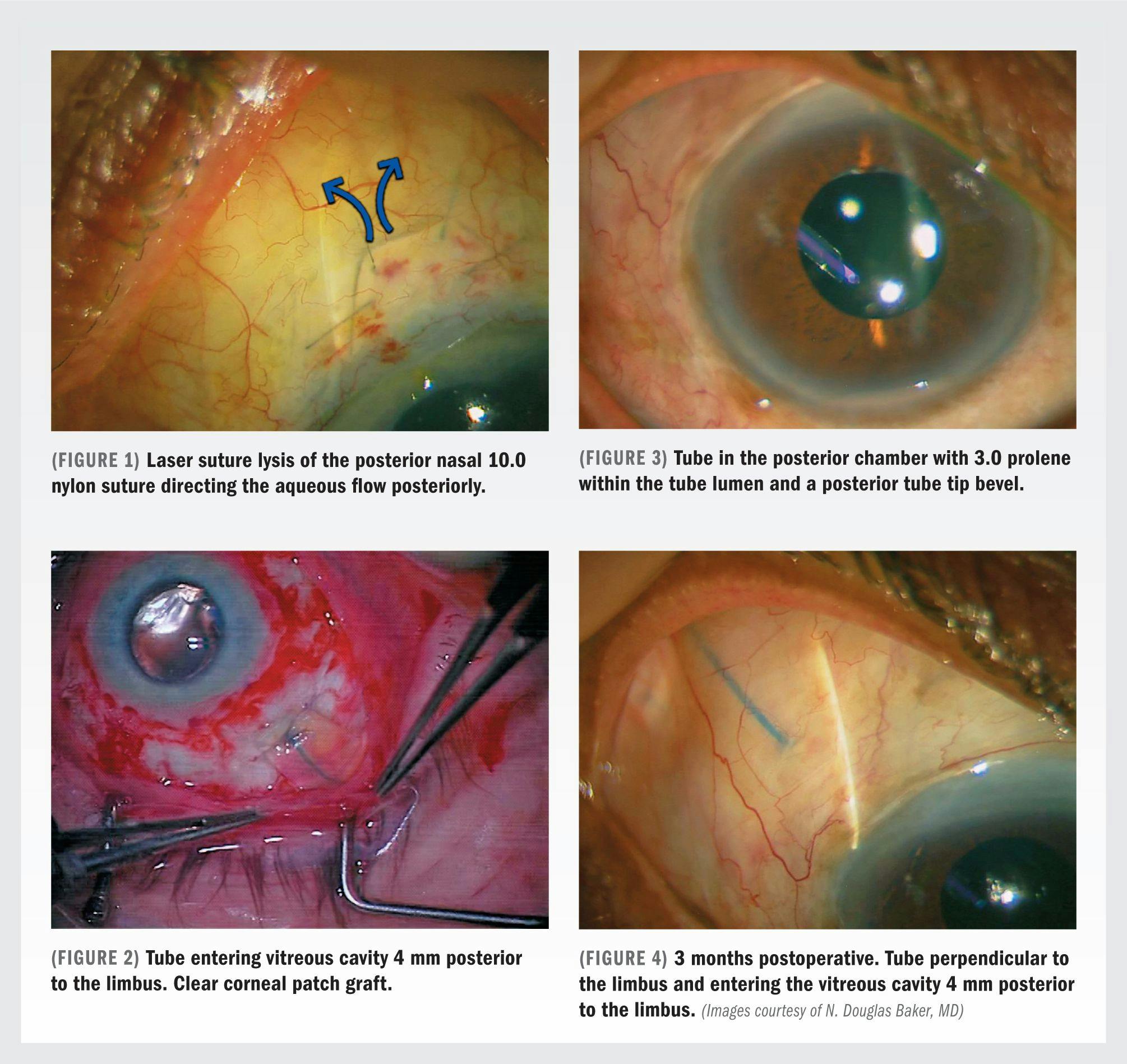 Intraoperative techniques in glaucoma focus on avoiding issues