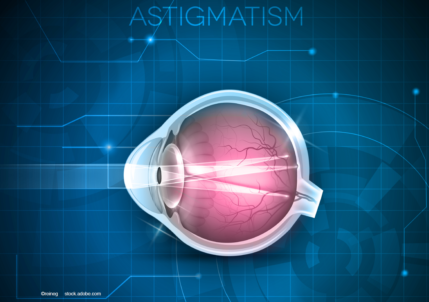 The investigators concluded that implantation of a toric IOL continues to be the procedure of choice to correct moderate astigmatism after cataract surgery. 