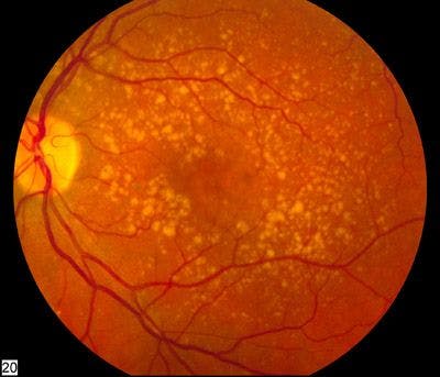 An image showing intermediate age-related macular degeneration at the back of the eye.
