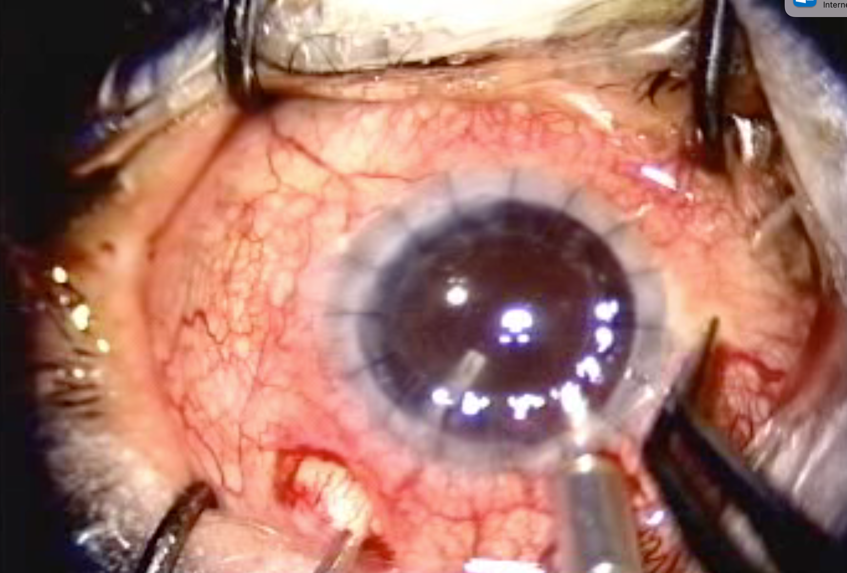 The ECP ciliary process. (Images and video courtesy of Victor H. Gonzalez, MD)