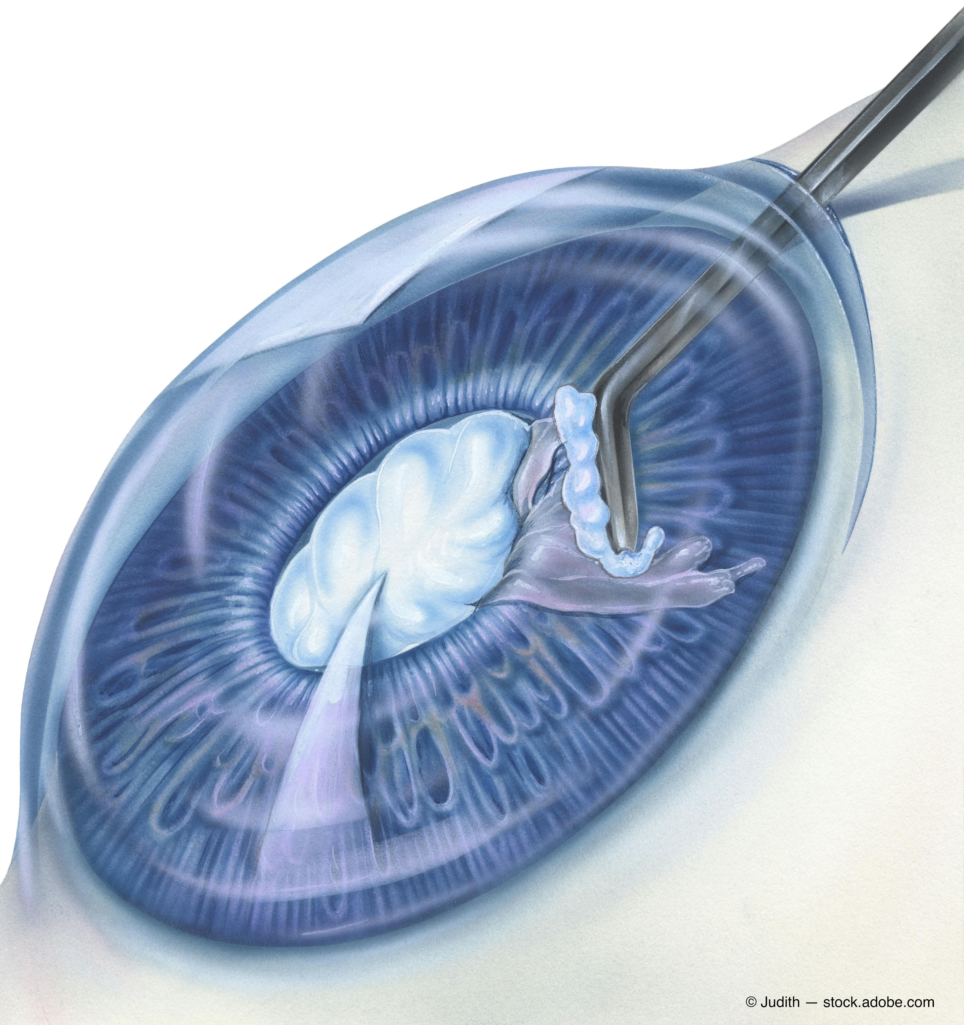 The history of progress and innovation in cataract surgery