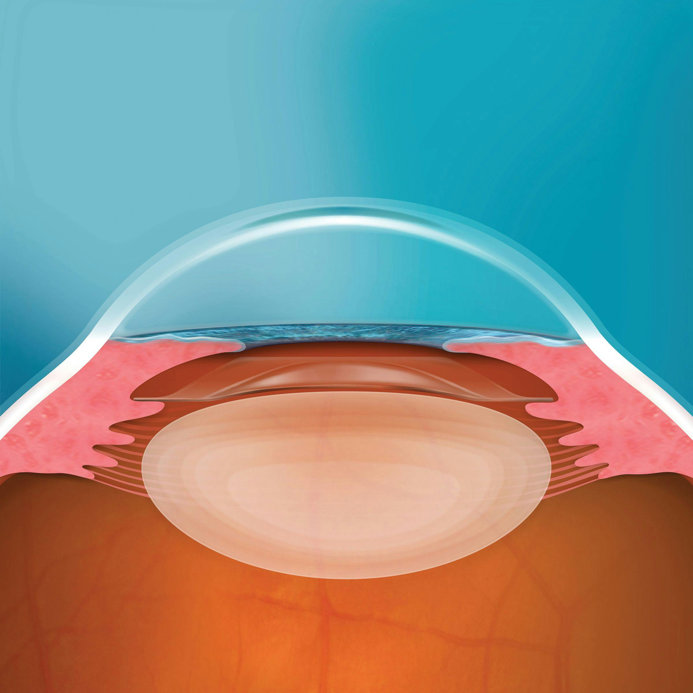 A lateral view of how an EVO is positioned in the eye. (Image courtesy of Brett Mueller II, DO, PhD)
