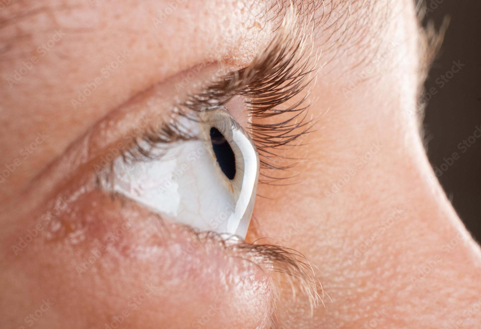 Keratoconus management: Lessons learned from an unusual time
