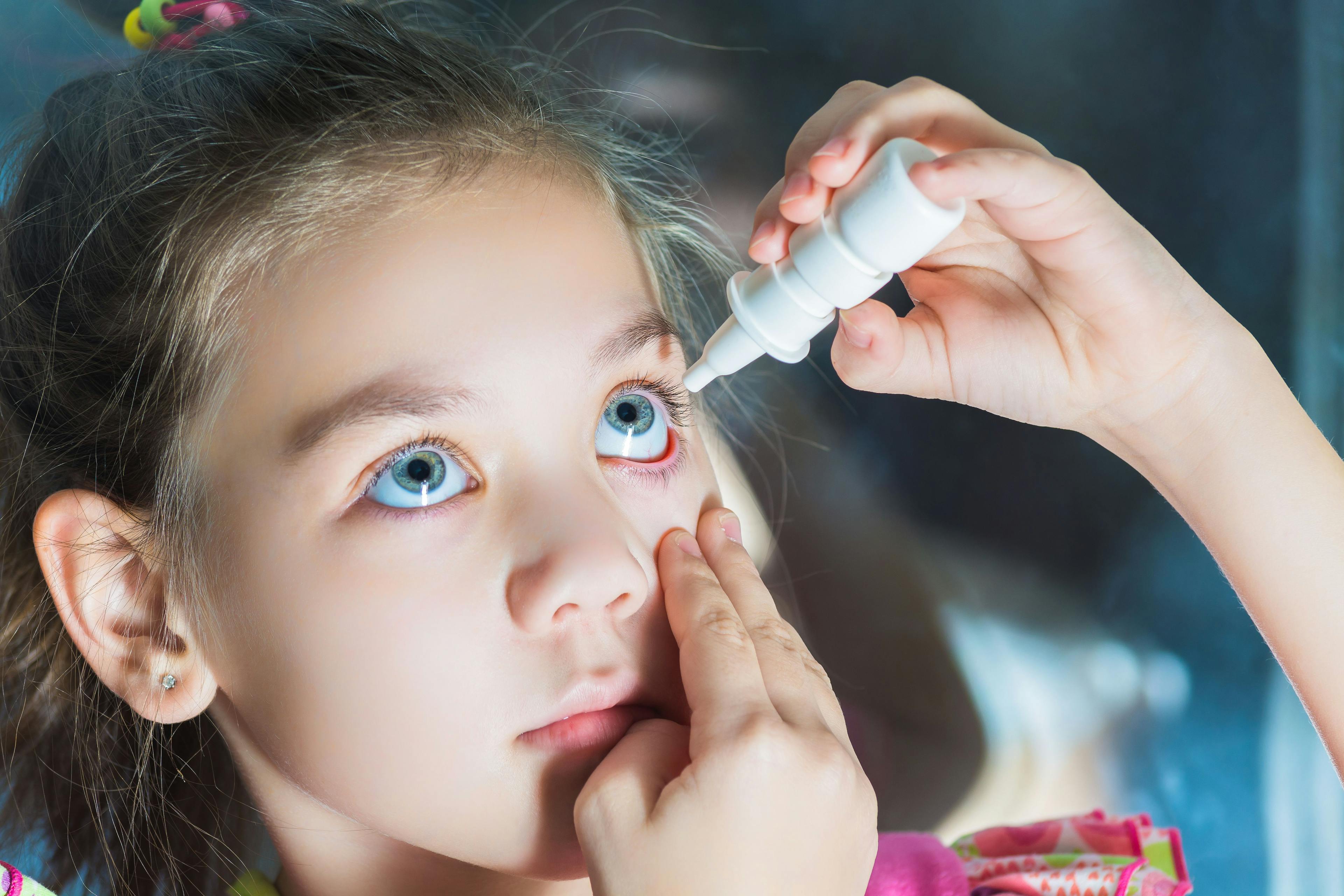 Medicated eye drops may delay myopia in children