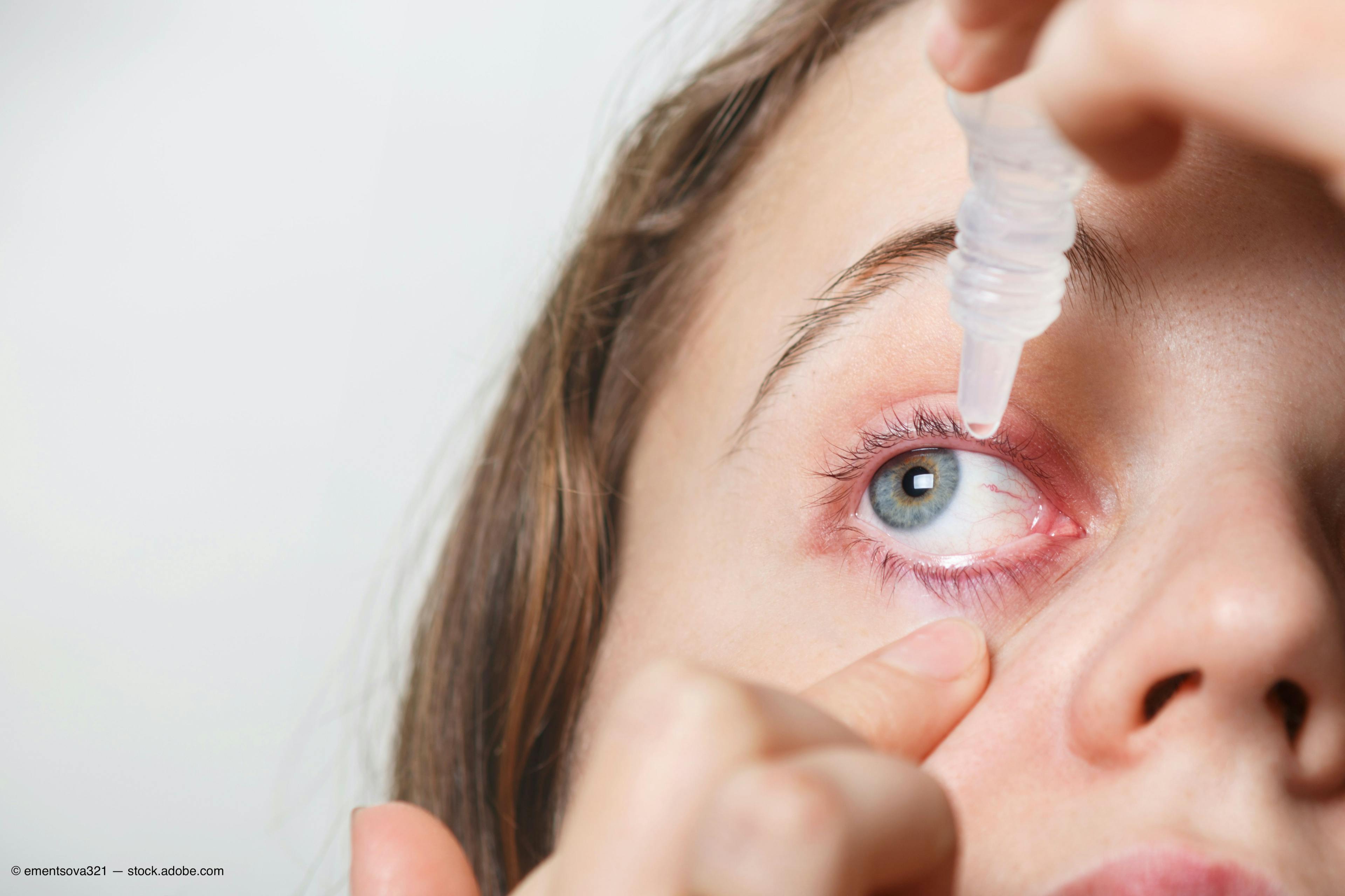 Myths and misconceptions about autologous serum for dry eye