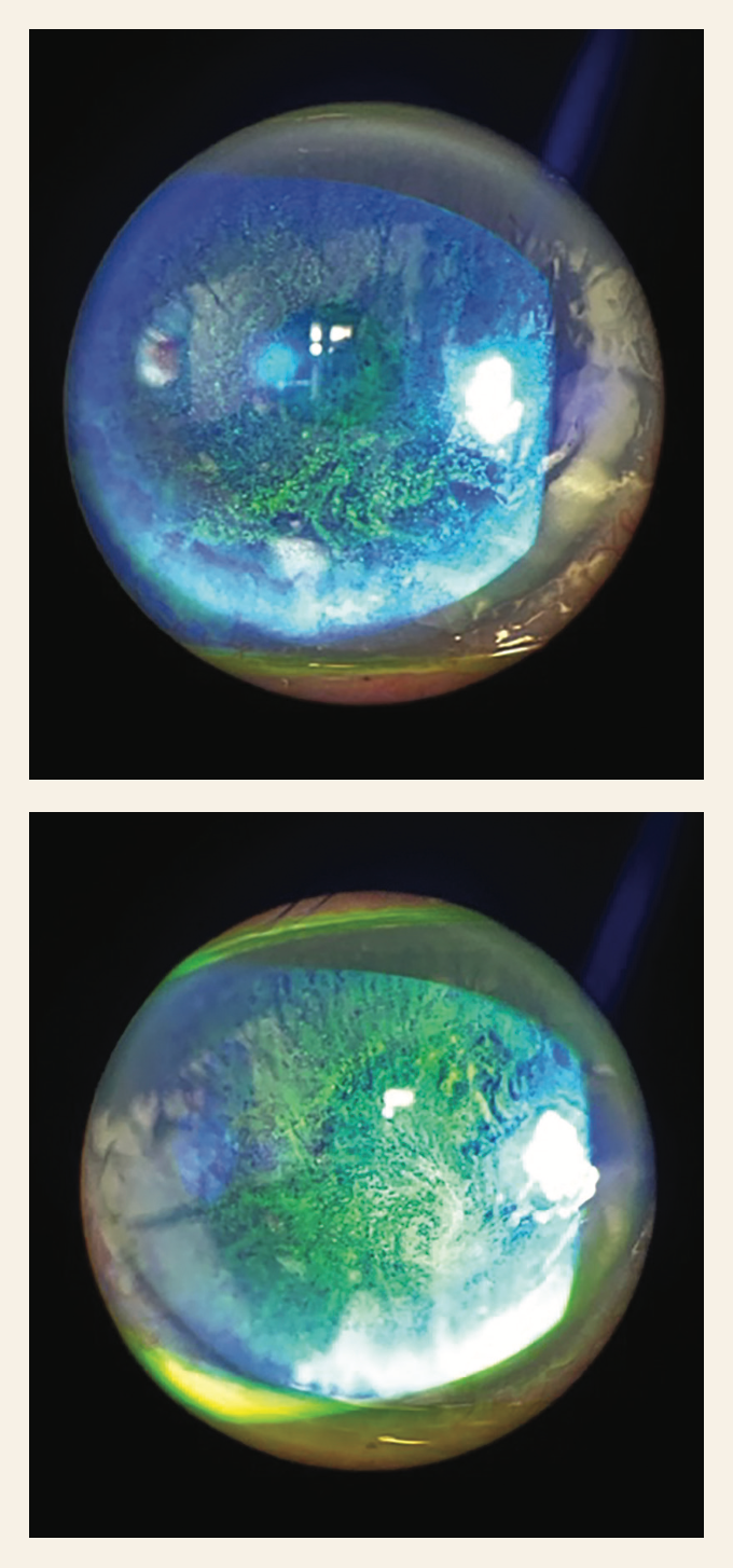 Two photos taken of a patient with dry eye which are currently treated with cyclosporine drops, omega 3 supplements, punctal plugs and amniotic membrane. (Images courtesy of James Kelly MD)
