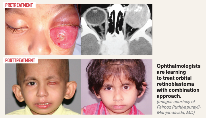 Ophthalmologists are learning to treat orbital retinoblastoma with combination approach.