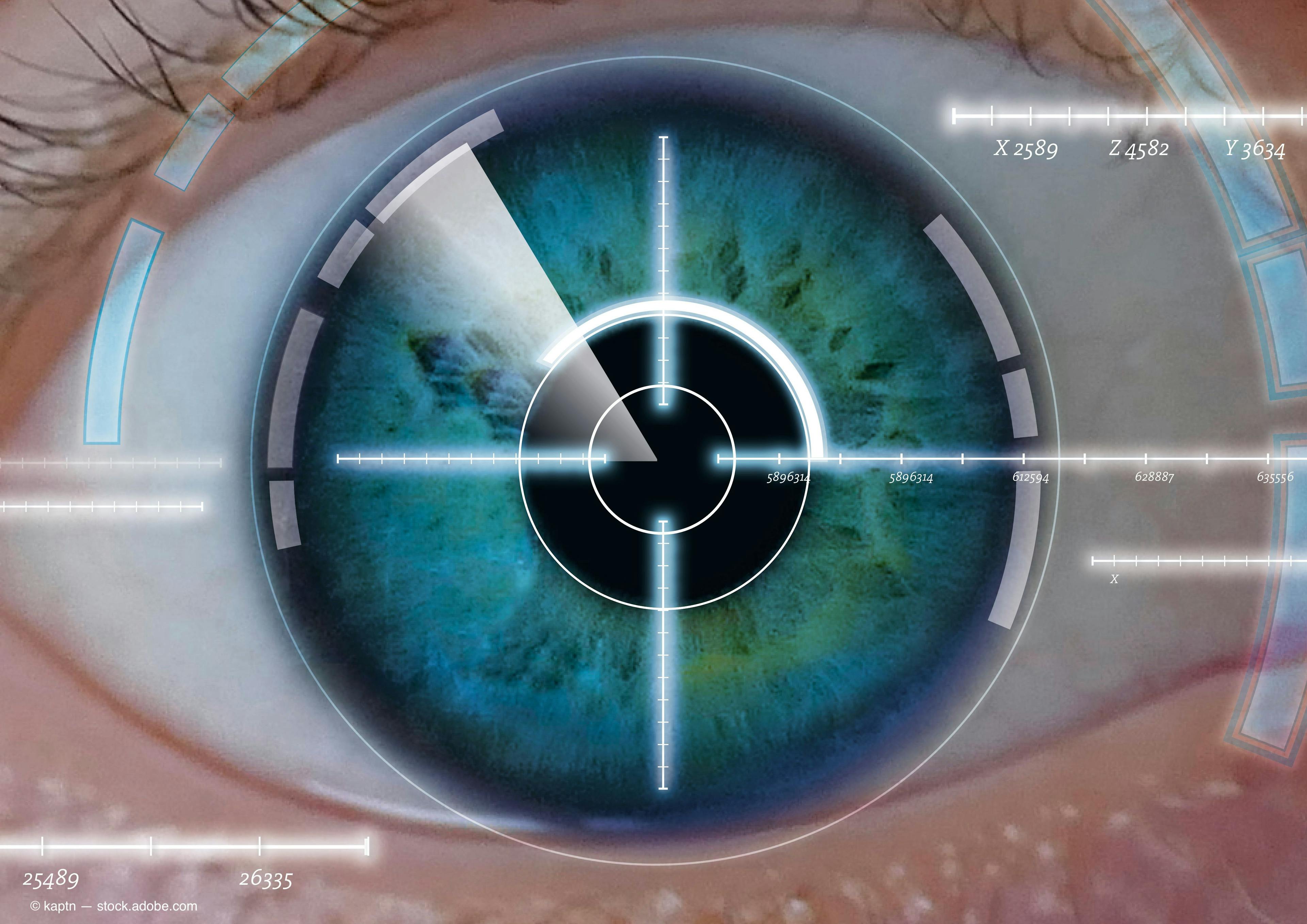 Corneal neurotization, a relatively new procedure that restores sensory innervation to a neurotrophic cornea by surgically transferring intact sensory donor nerve fibers to the cornea, seems to be safe and effective and can improve vision.