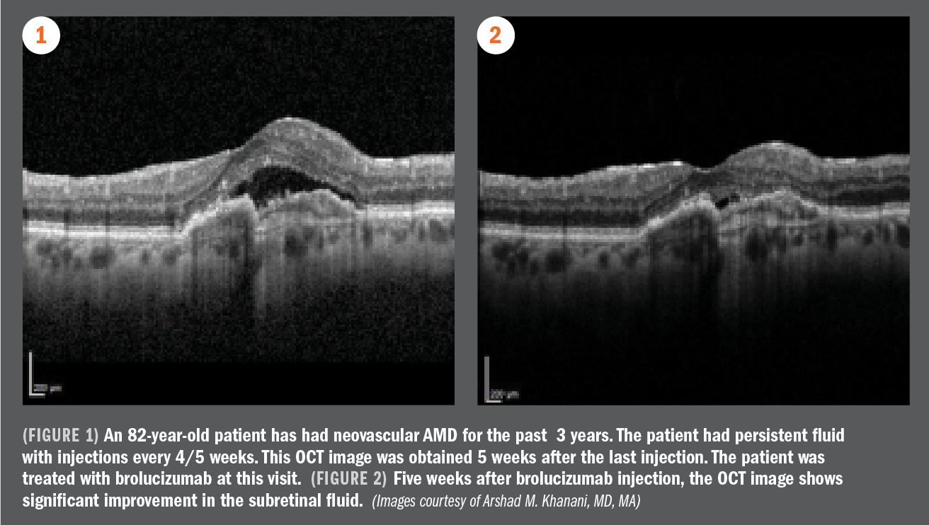 Brolucizumab: Less frequent dosing/maintenance of robust visual gains in wet AMD