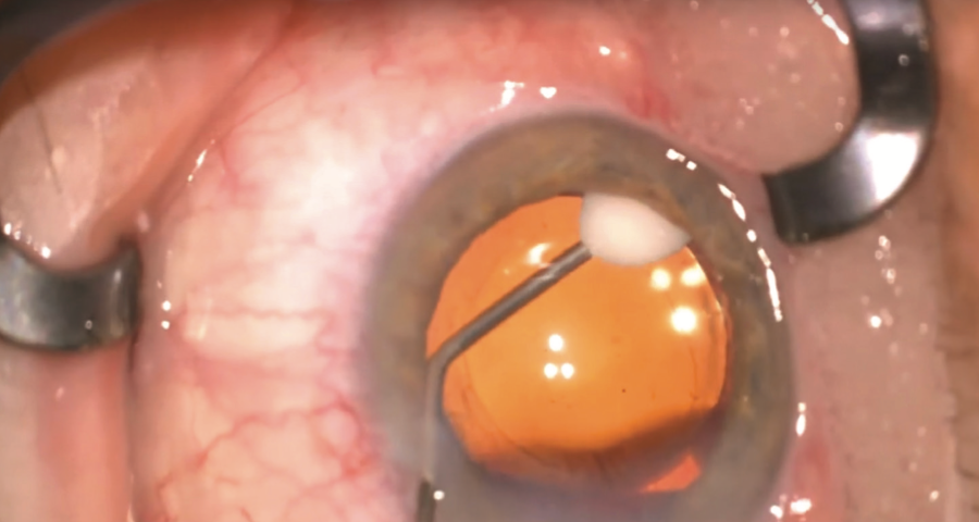 Real-world outcomes validate intraocular drug delivery method 