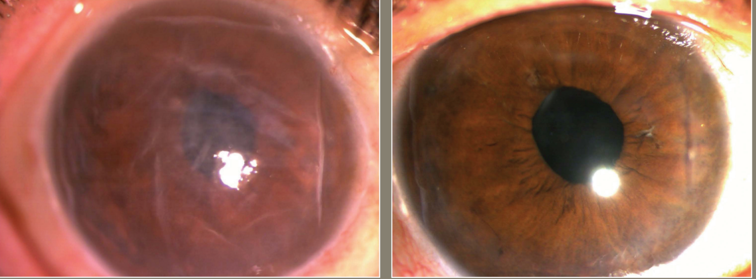 Landmark treatment: Cell therapy advances options for corneal endothelial disease