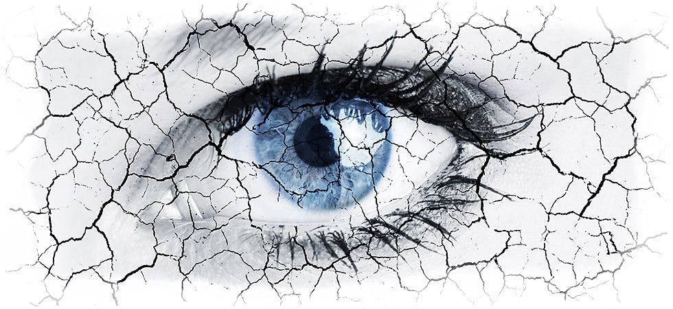 Can depression drive severity of dry eye symptoms, inflammatory markers?