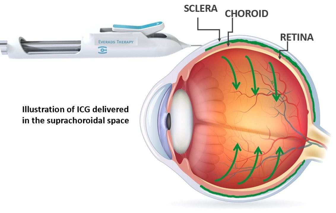 Suprachoroidal delivery system gets drug to the macula, posterior segment