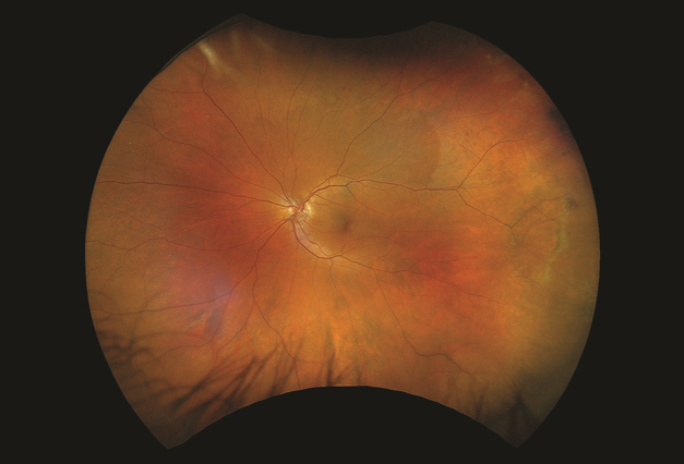 Optos unveils ultra-widefield color image modality, offering increased retinal visualization to ophthalmologists