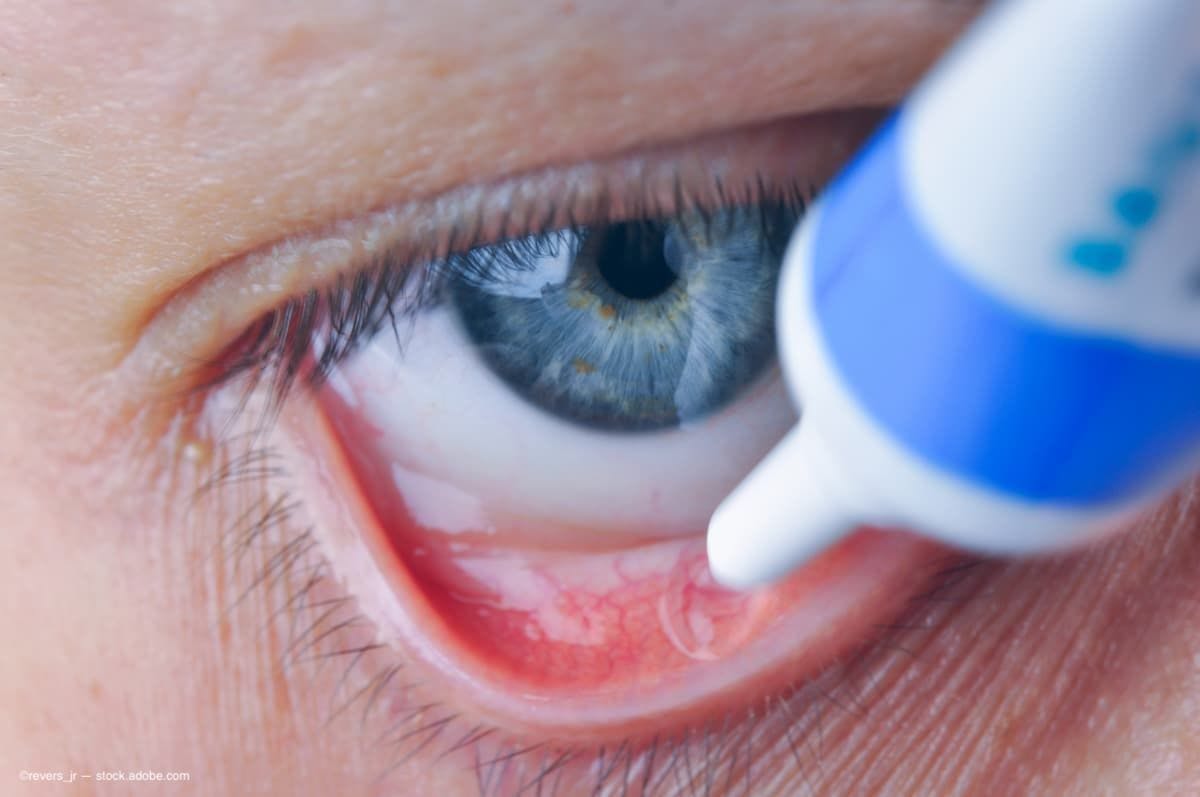 Brassica Pharma voluntarily recalls eye ointments over sterility concerns
