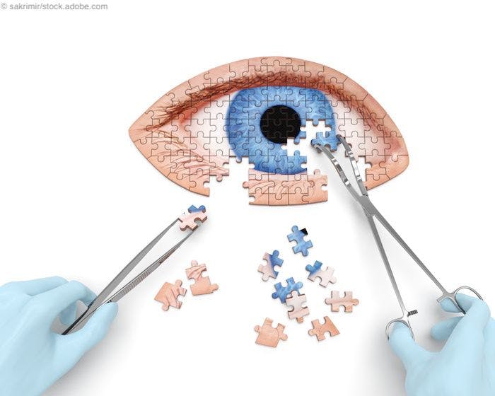 Study: Elios combined with cataract surgery,  delivers significant IOP reduction out to 8 years