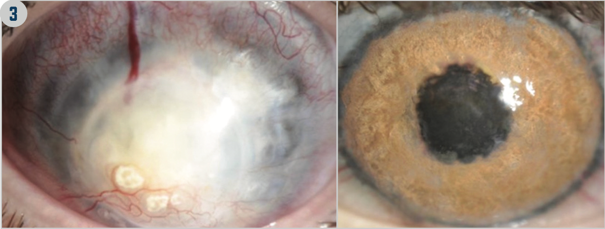 FIGURE 1. Instruments Used in Keratopigmentation

FIGURE 2. Femtosecond-Assisted Intrastromal Keratopigmentation

FIGURE 3. Superficial Keratopigmentation (Images courtesy of Jorge L. Alió, MD, PhD, FEBOphth)