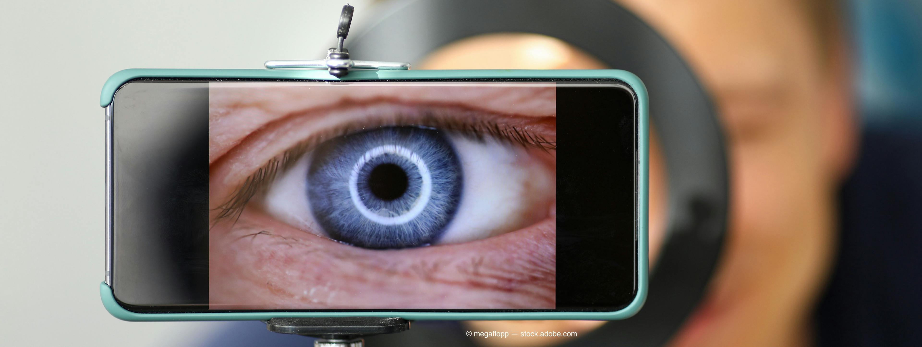 A smartphone direct ophthalmoscope attachment (D-EYE) has proved easy to use and successful in visualizing the optic disc compared with the direct ophthalmoscope