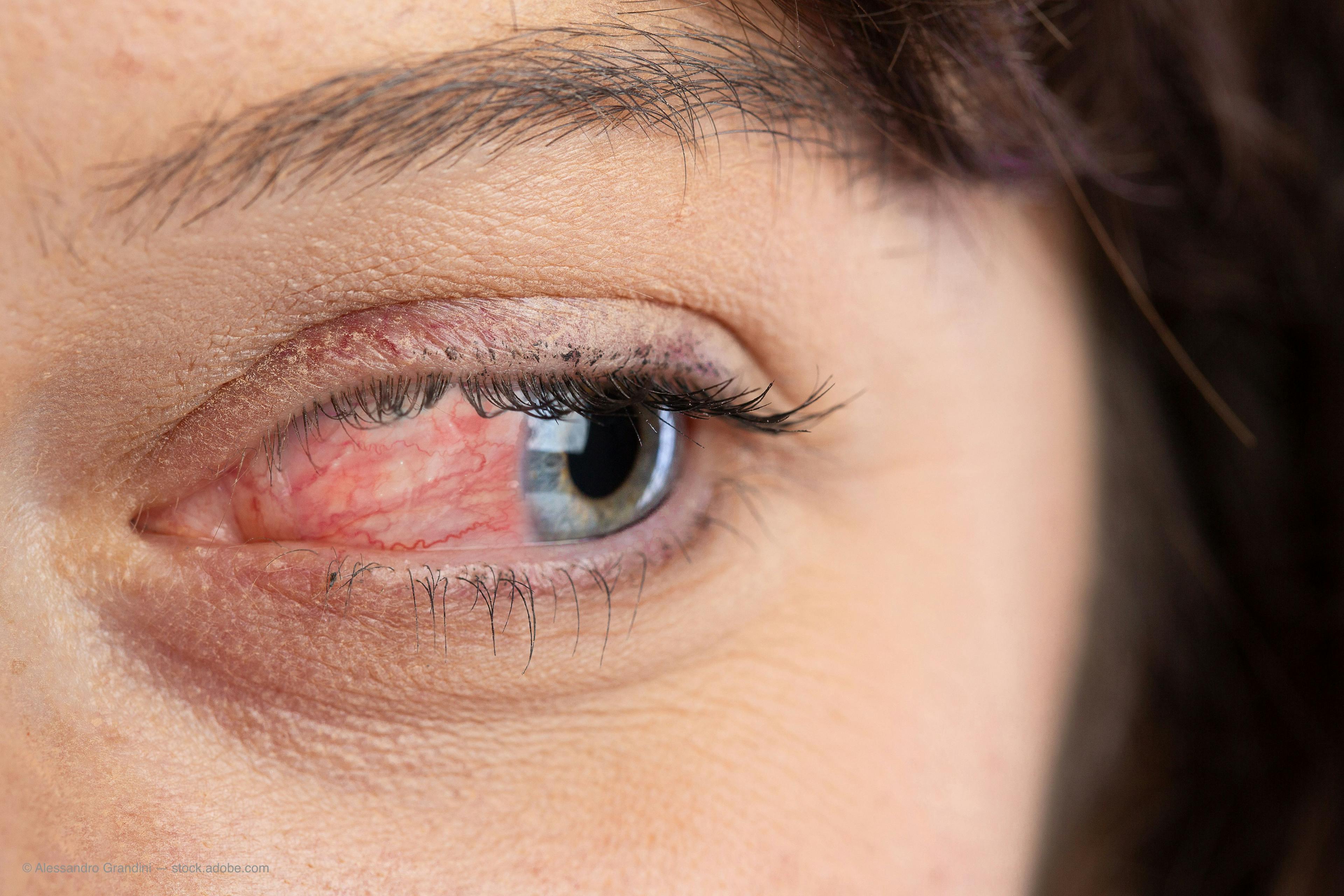 VA, visual function are going the way of ocular inflammation