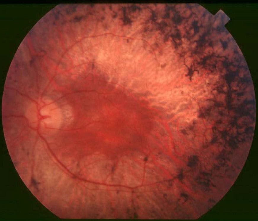 A fundus image showing retinitis pigmentosa. File photo