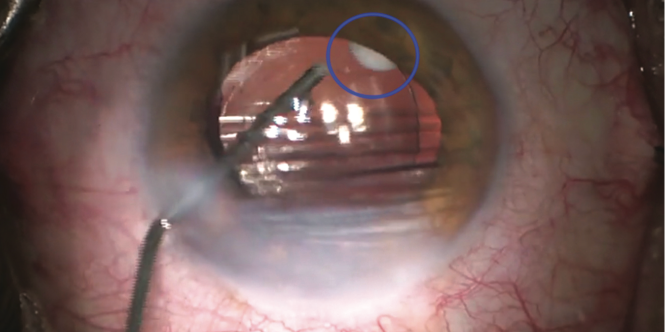 Dexycu (blue circle) is administered at the end of cataract surgery and can be visualized by the surgeon. (Image courtesy of Inder Paul Singh, MD)